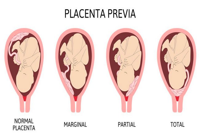 Placenta praevia types