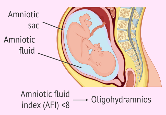 Oligohydramnios causes