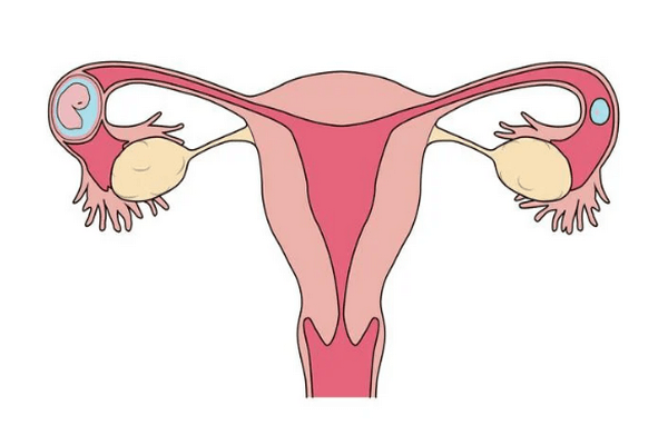 Tubal pregnancy symptoms